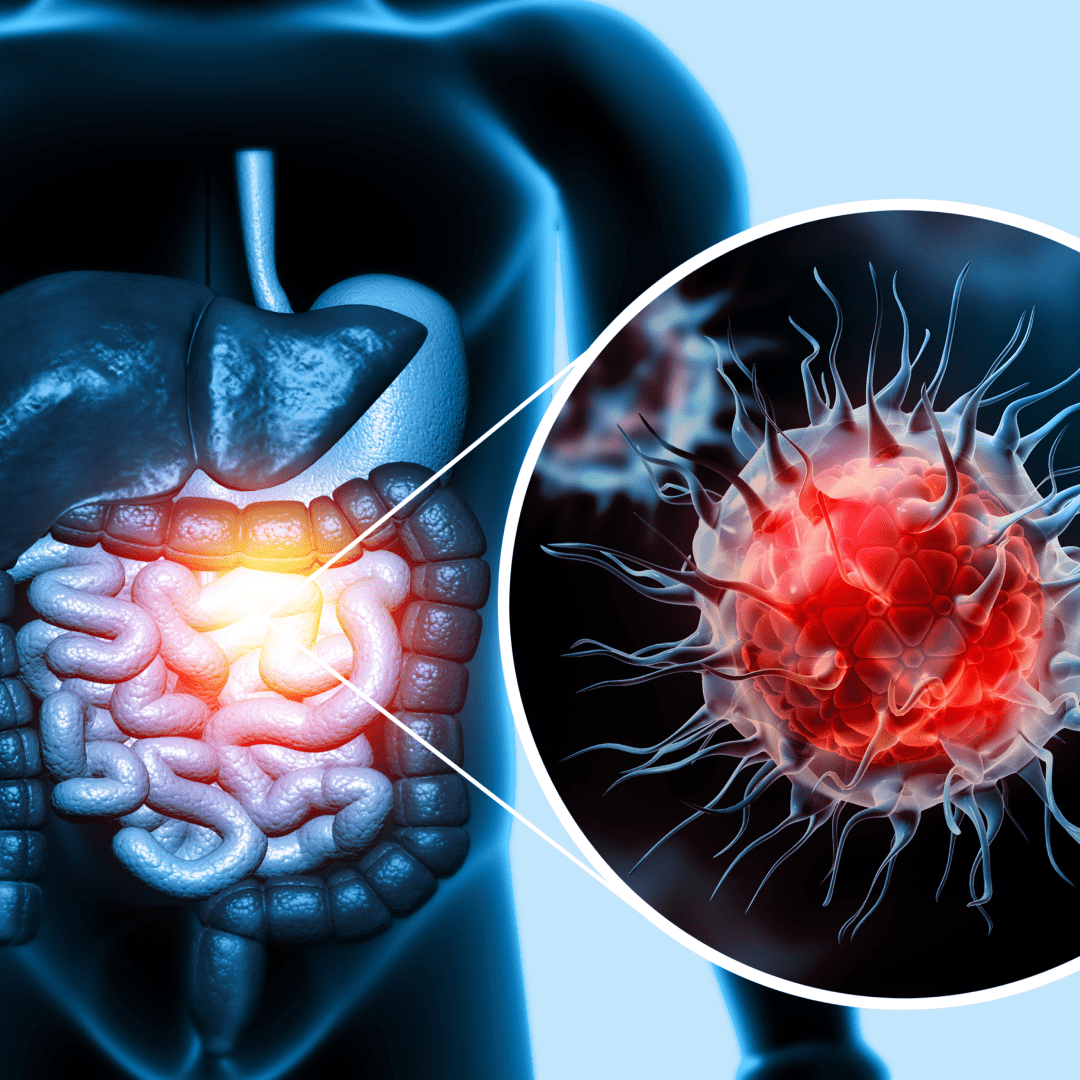 Human digestive system with inflamed area highlighted.